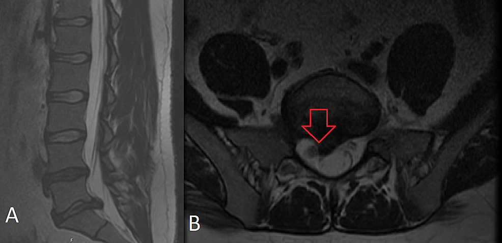 A.-T2-sagittal-MRI-of-the-lumbar-spine-w/o-contrast-B.-Axial-MRI-of-the-lumbar-spine-w/o-contrast