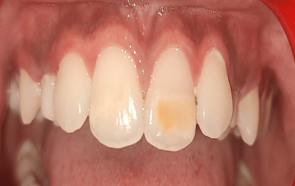 Management of Turner's Hypoplasia Using Resin Infiltration A Case Report Cureus