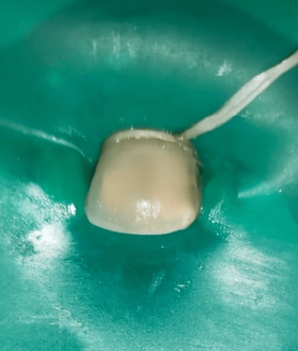 Management of Turner's Hypoplasia Using Resin Infiltration A Case Report Cureus