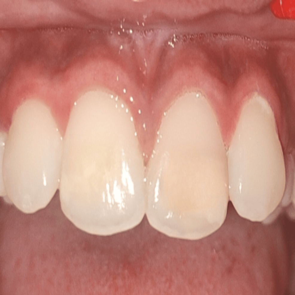 Management of Turner's Hypoplasia Using Resin Infiltration A Case Report Cureus