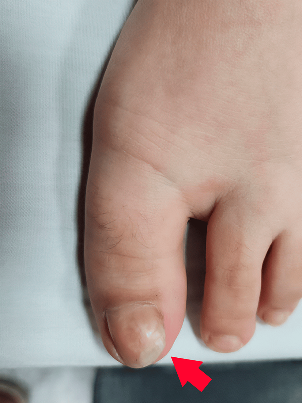 Pincer Toe nails: You've seen them; did you know what they were and how  they got that way? Or, did you dismiss them? — The Gait Guys