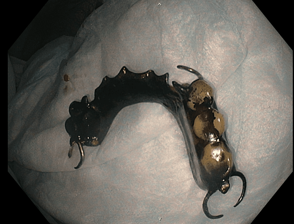 Streptococcus viridans Liver Abscess and Septicemia Likely Secondary to