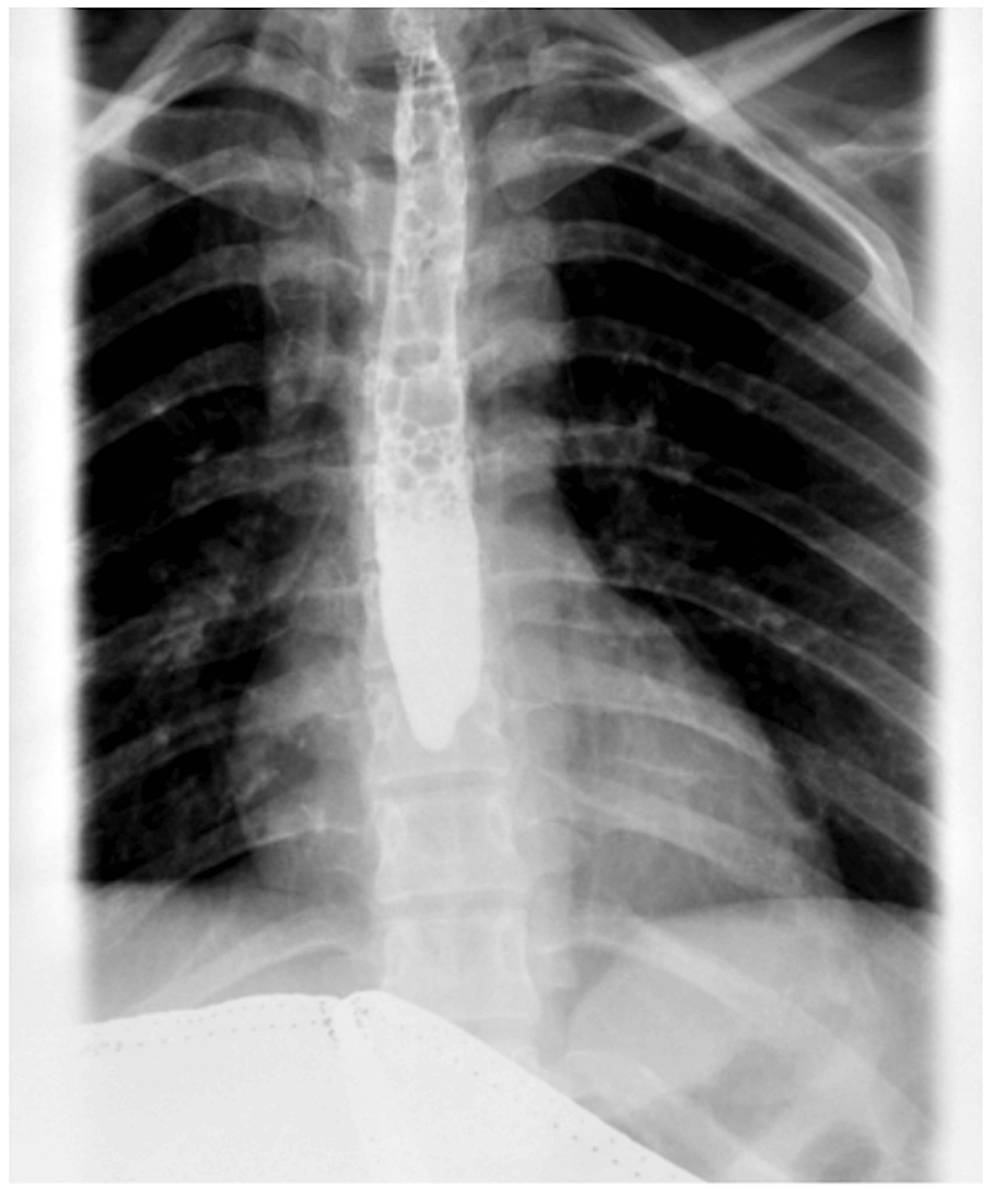 Cureus | An Interesting Presentation of Pneumomediastinum Secondary to ...