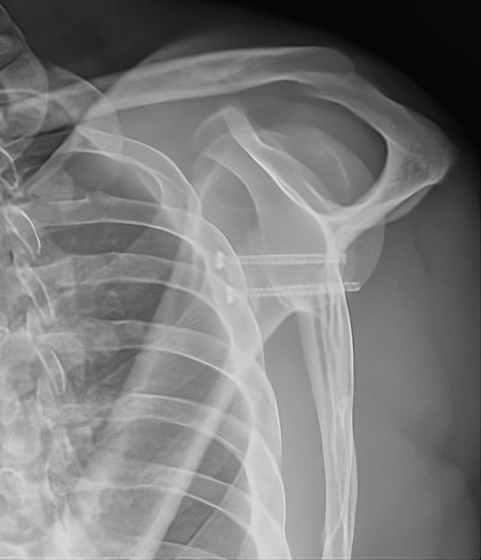 The Successful Resolution of Bilateral Recurrent Shoulder Dislocation