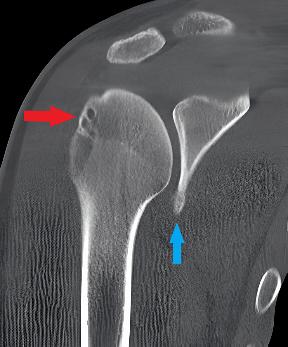 The Successful Resolution of Bilateral Recurrent Shoulder Dislocation