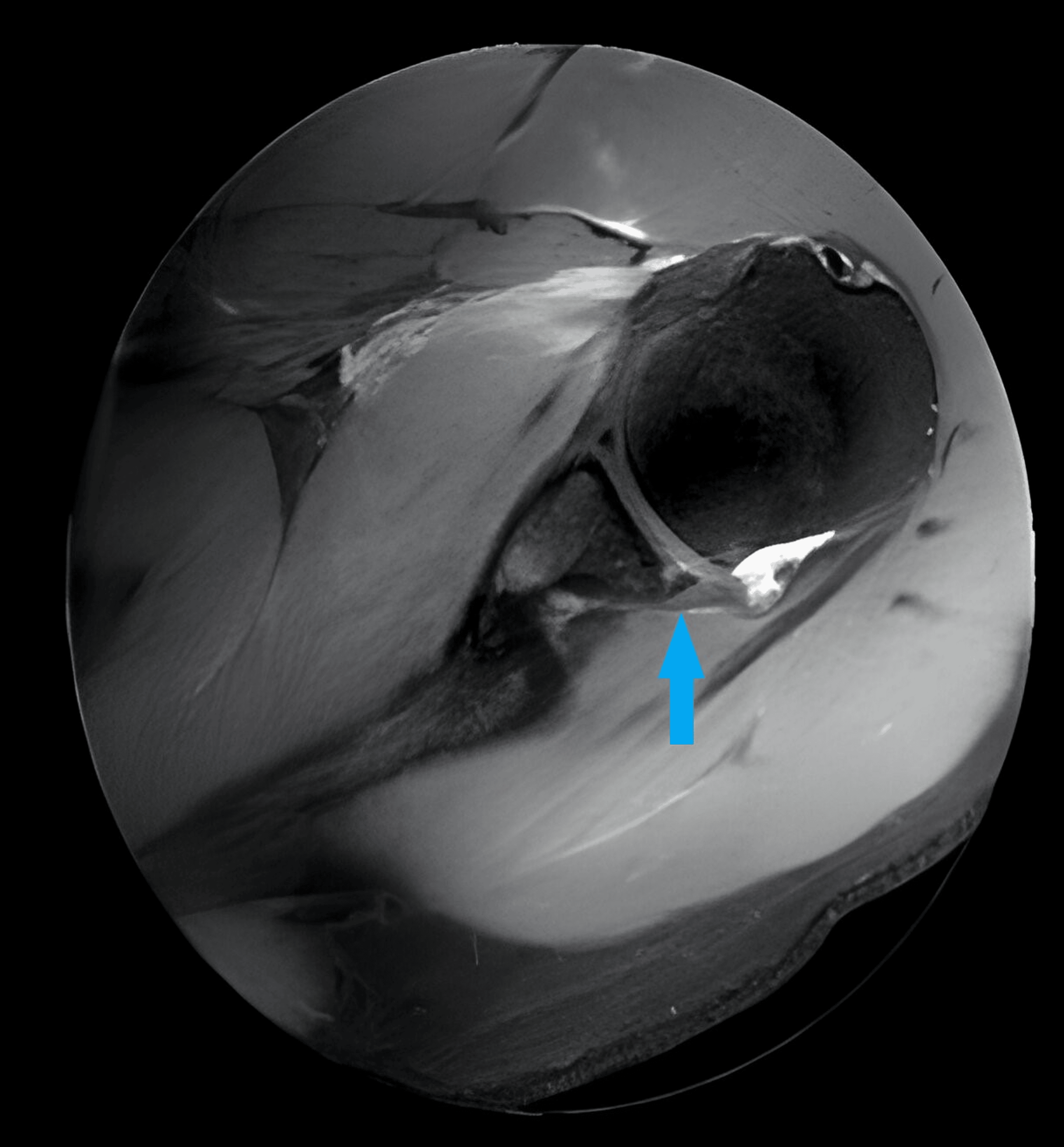 Cureus The Successful Resolution of Bilateral Recurrent Shoulder