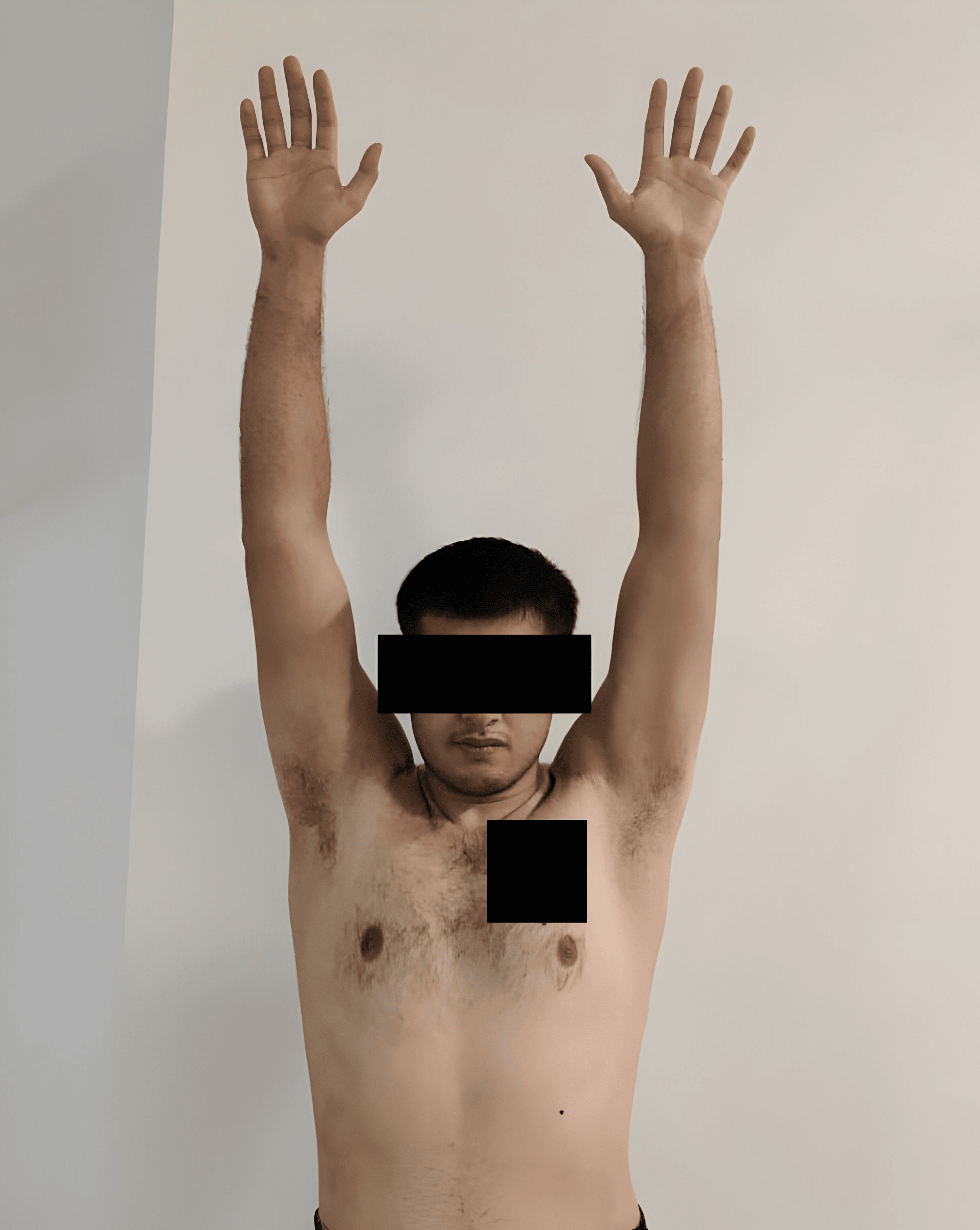 The Successful Resolution Of Bilateral Recurrent Shoulder Dislocation With The Bilateral