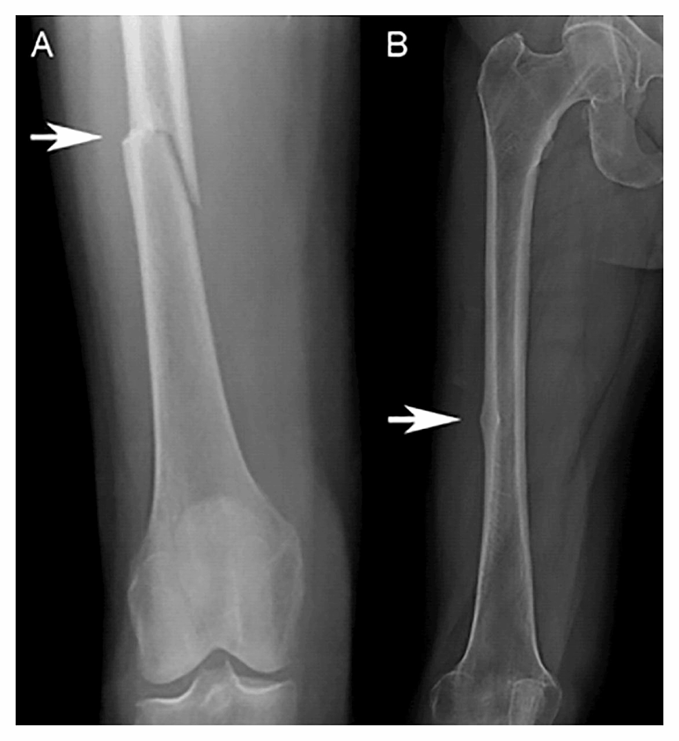 Cureus Bisphosphonates And Atypical Femur Fractures Is The