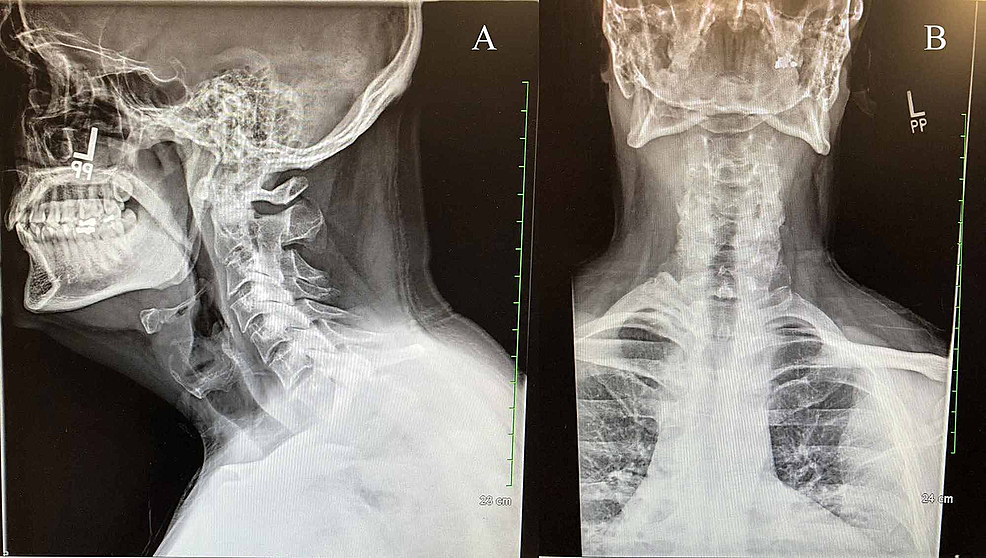 Cureus | Delayed Diagnosis Of Ankylosing Spondylitis: A Missed Opportunity?