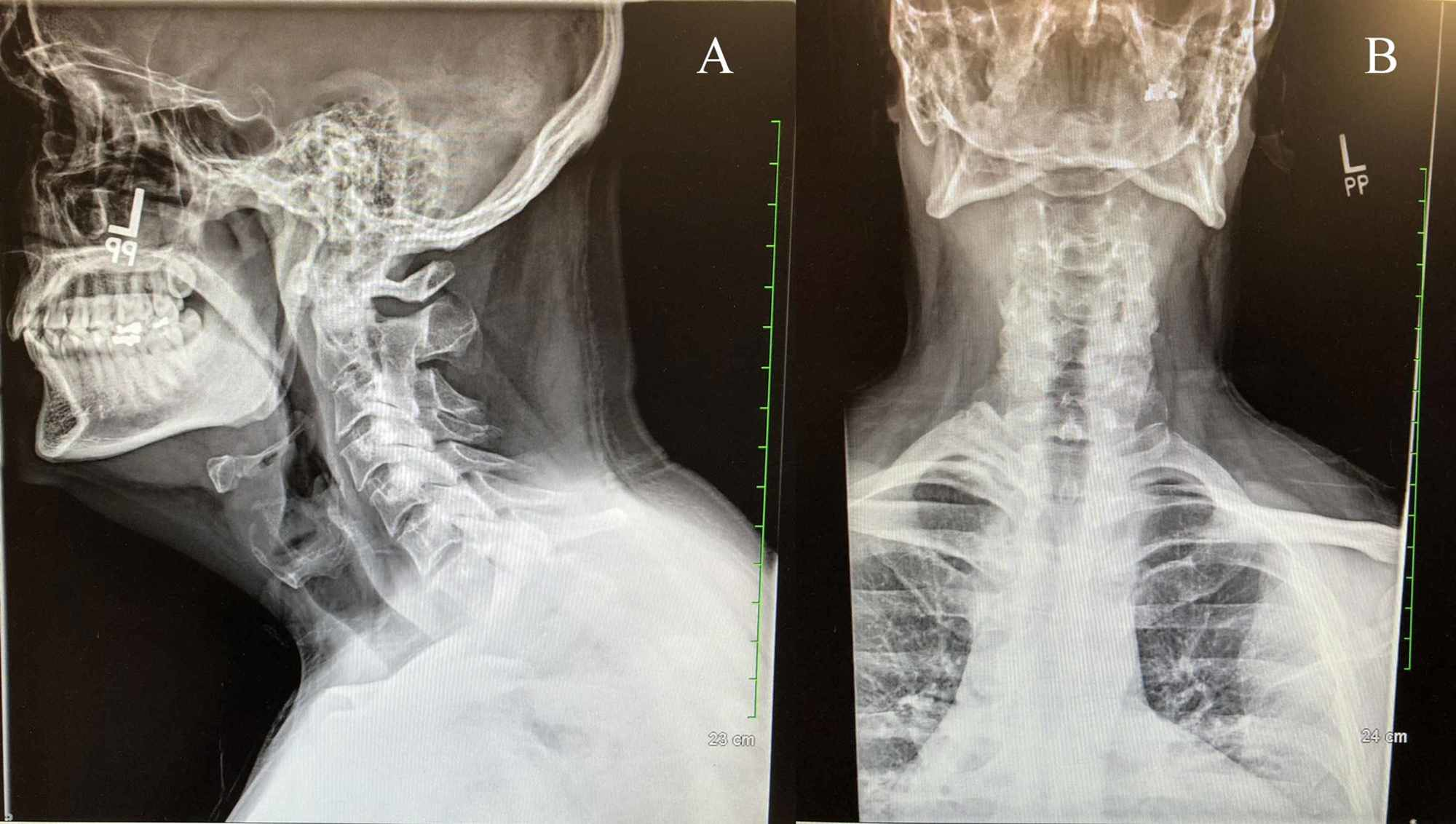 infection of the cervical spine x ray