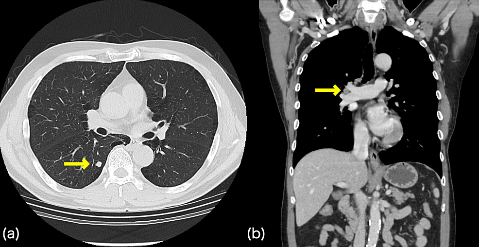 Cureus A Case Of Paraneoplastic Neurological Syndrome Leading To The Diagnosis Of Large Cell