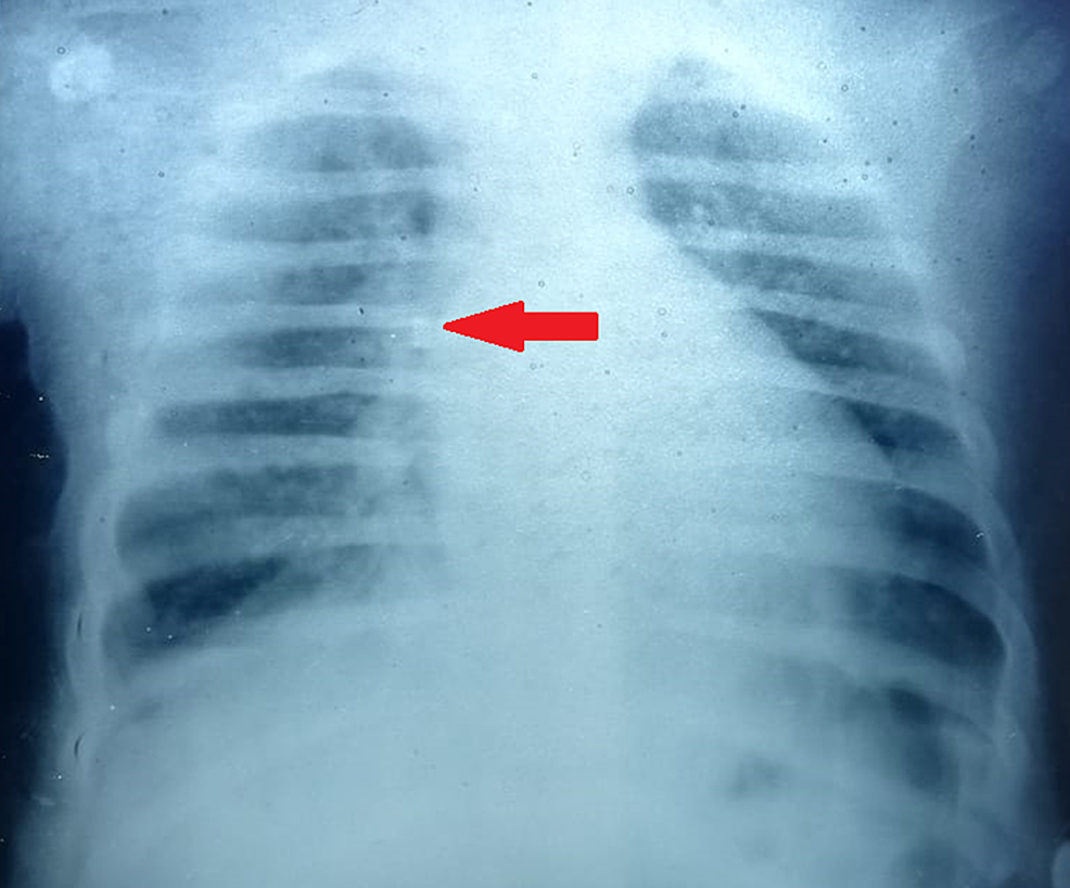 bronchopneumonia x ray findings