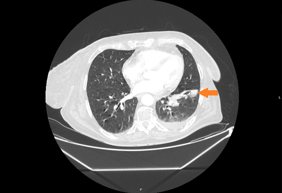 Pulmonary-mass-(SCLC)-in-the-left-lower-lobe-with-ipsilateral-hilar-lymphadenopathy-and-pleural-effusion.