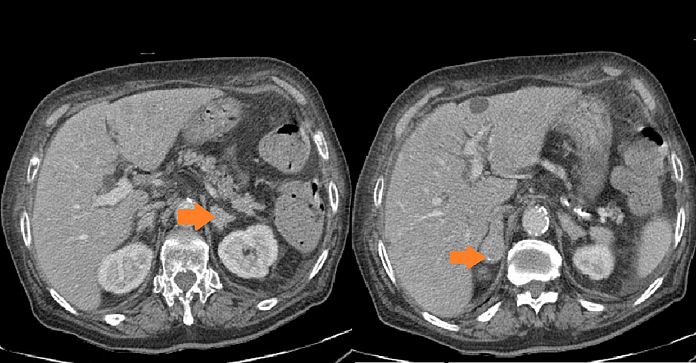 Bilateral-suprarenal-lesions-suggestive-of-secondary-involvement.