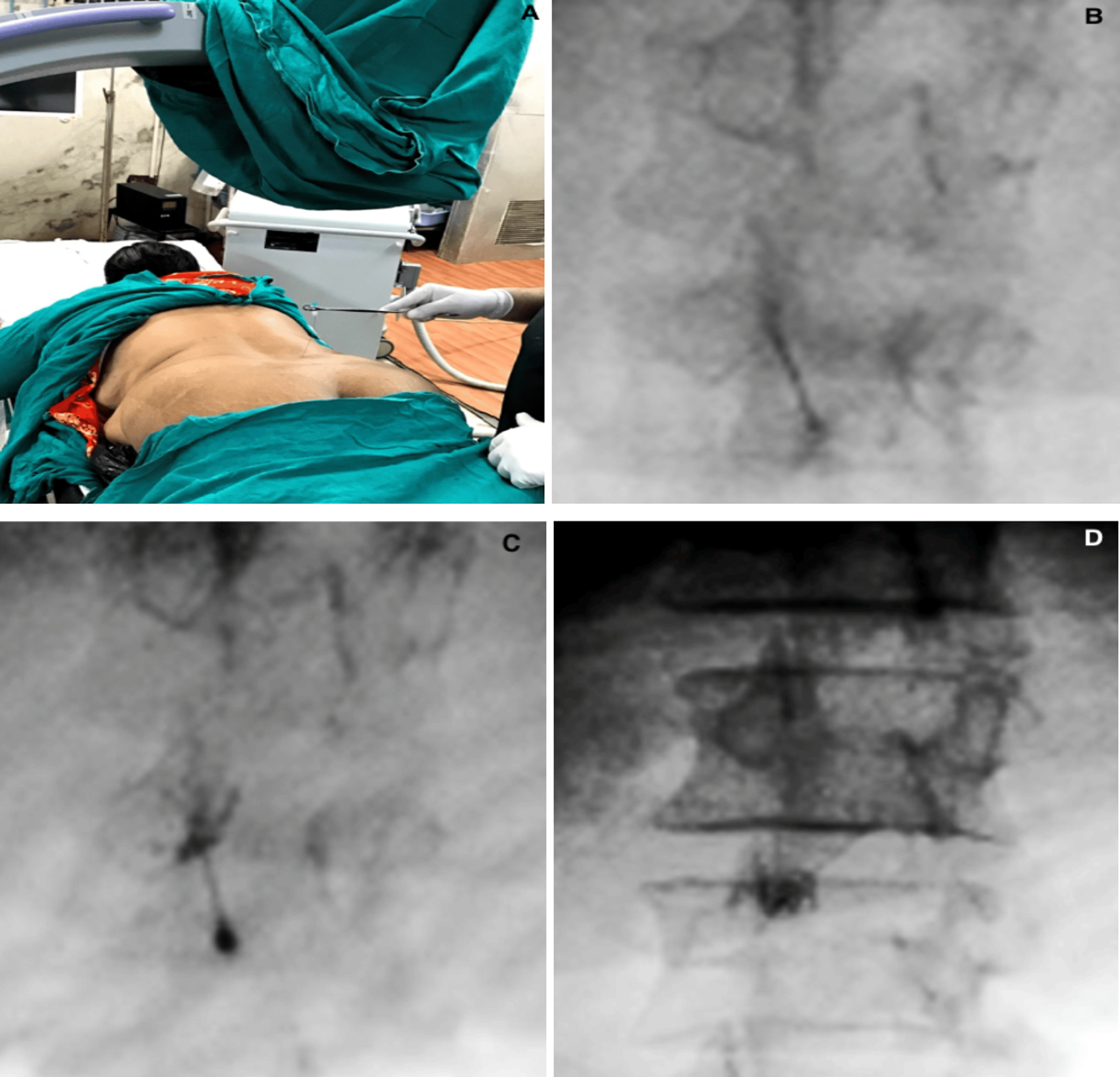 Comparative Evaluation of Intraarticular Facet Joint Injection Versus