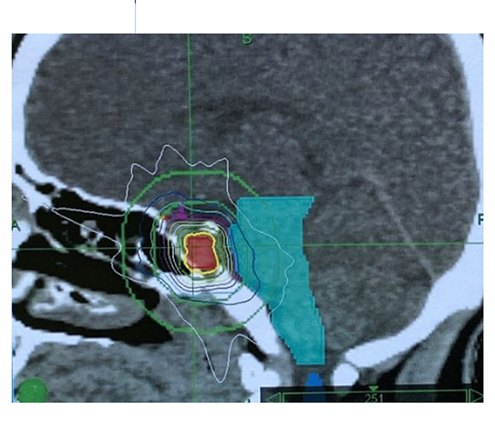 Gamma Knife radiosurgery for acromegaly: Evaluating the role of