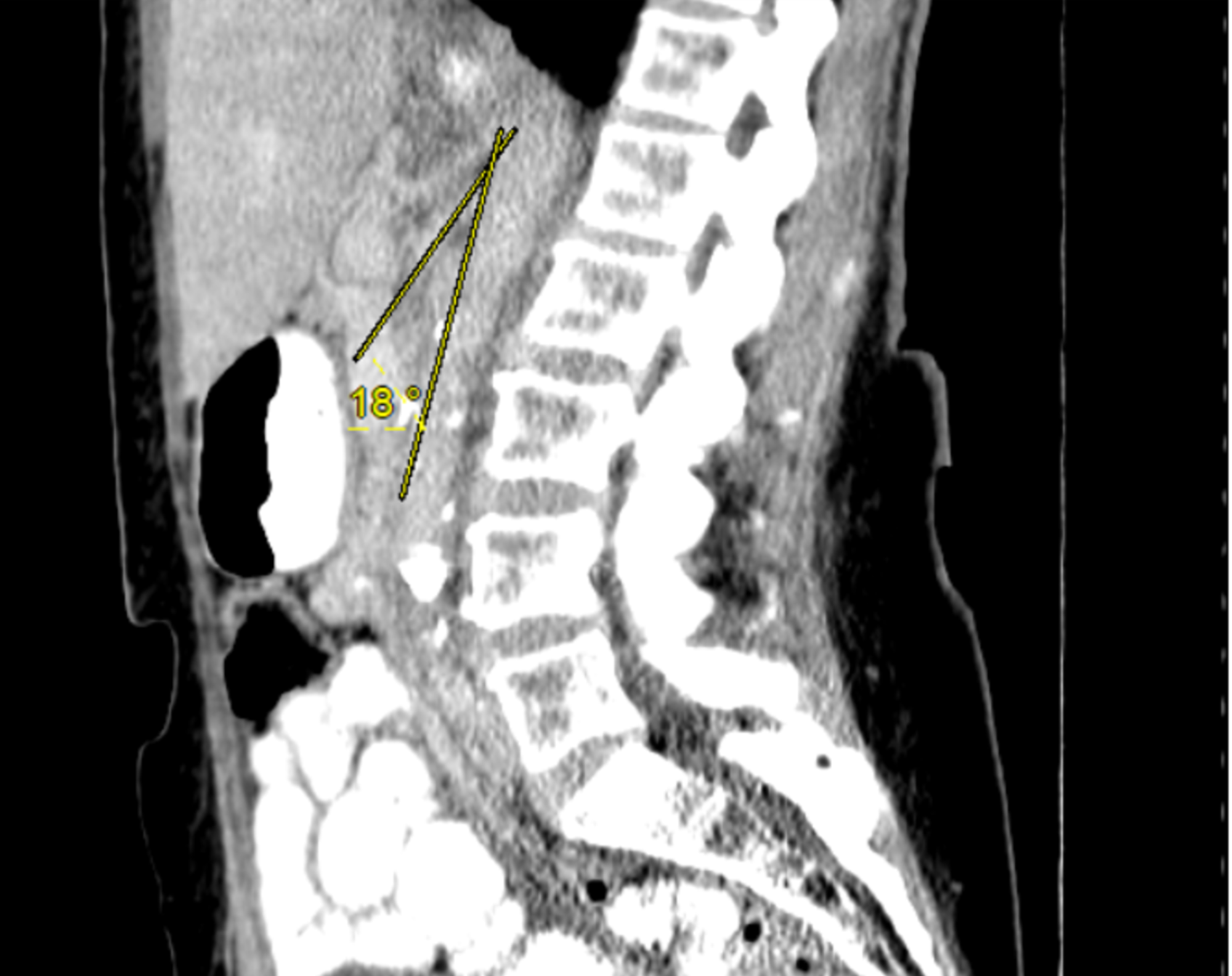 Cureus | A Case of Wilkie’s Syndrome: Consideration of Alternative ...