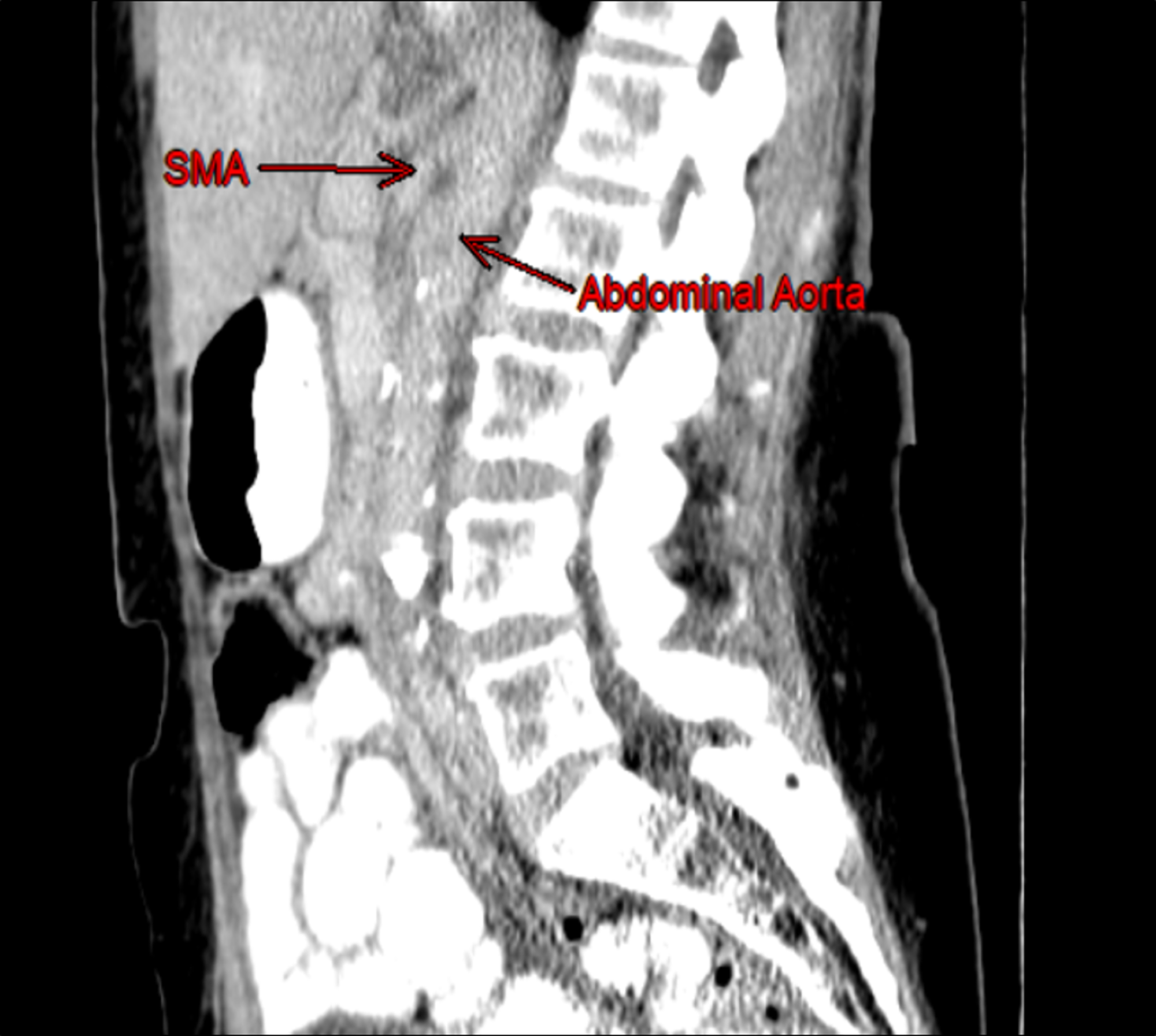 Cureus A Case Of Wilkie S Syndrome Consideration Of Alternative Diagnosis In The Setting Of Chronic Abdominal Pain