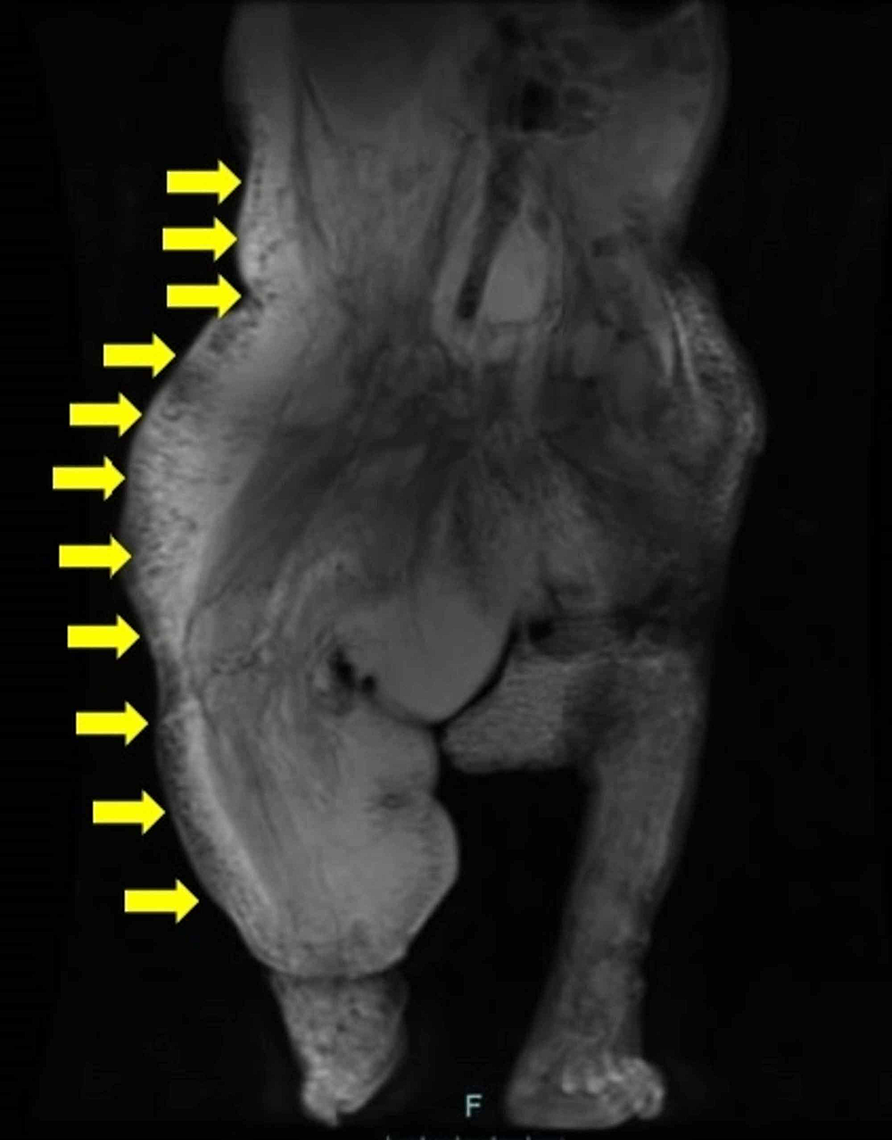 Cureus CLOVES Syndrome in a Ninemonthold Infant
