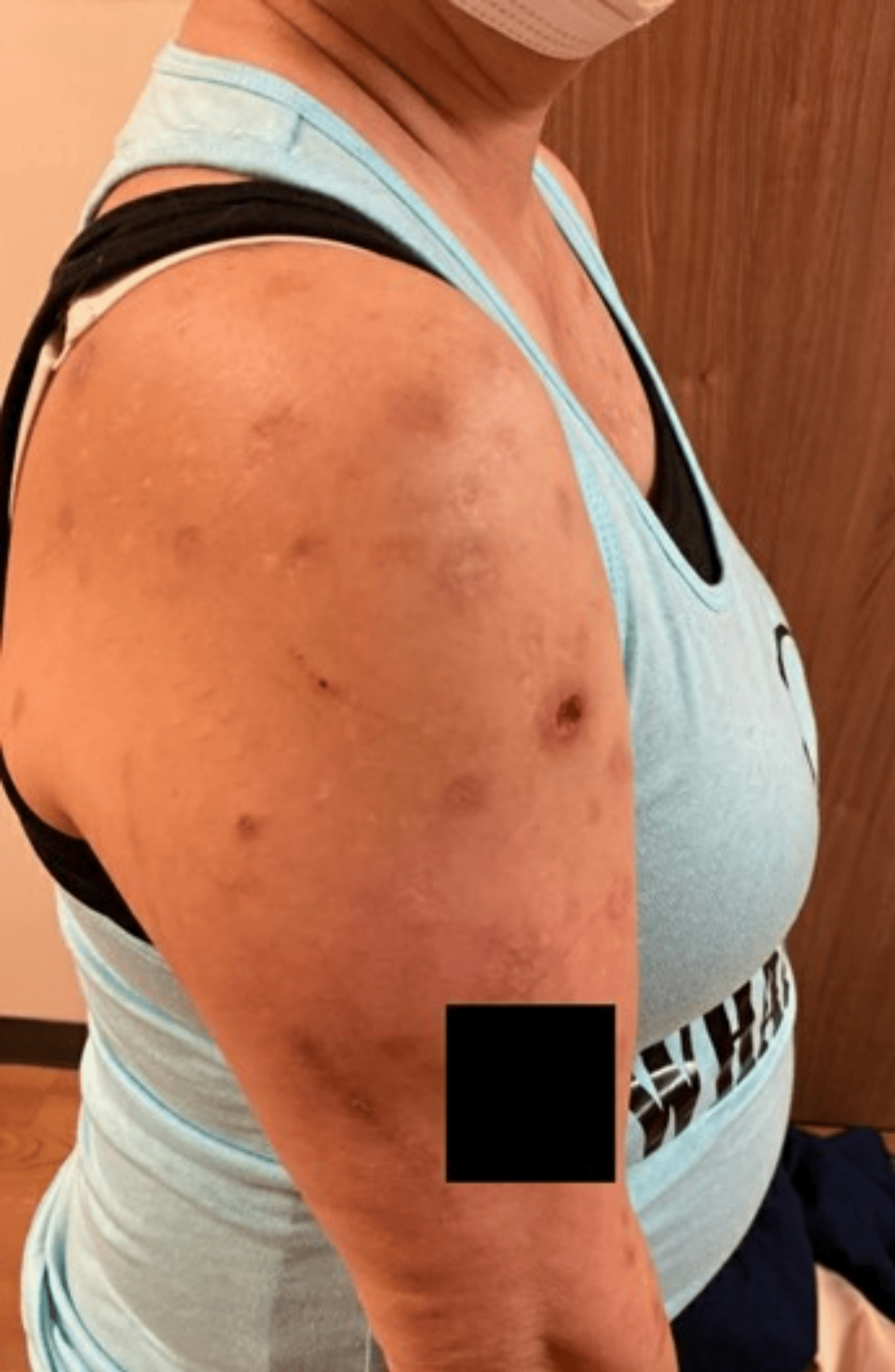 Low-Dose Naltrexone for Excoriation Disorder | Cureus