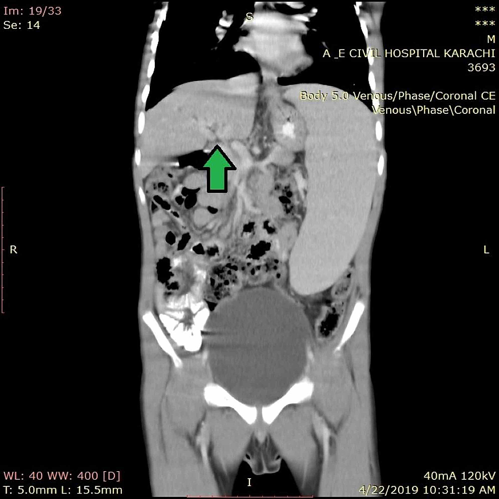 Coronal-section-of-CT-abdomen-of-patient-showing-cavernous-transformation-of-portal-vein-at-porta-hepatis