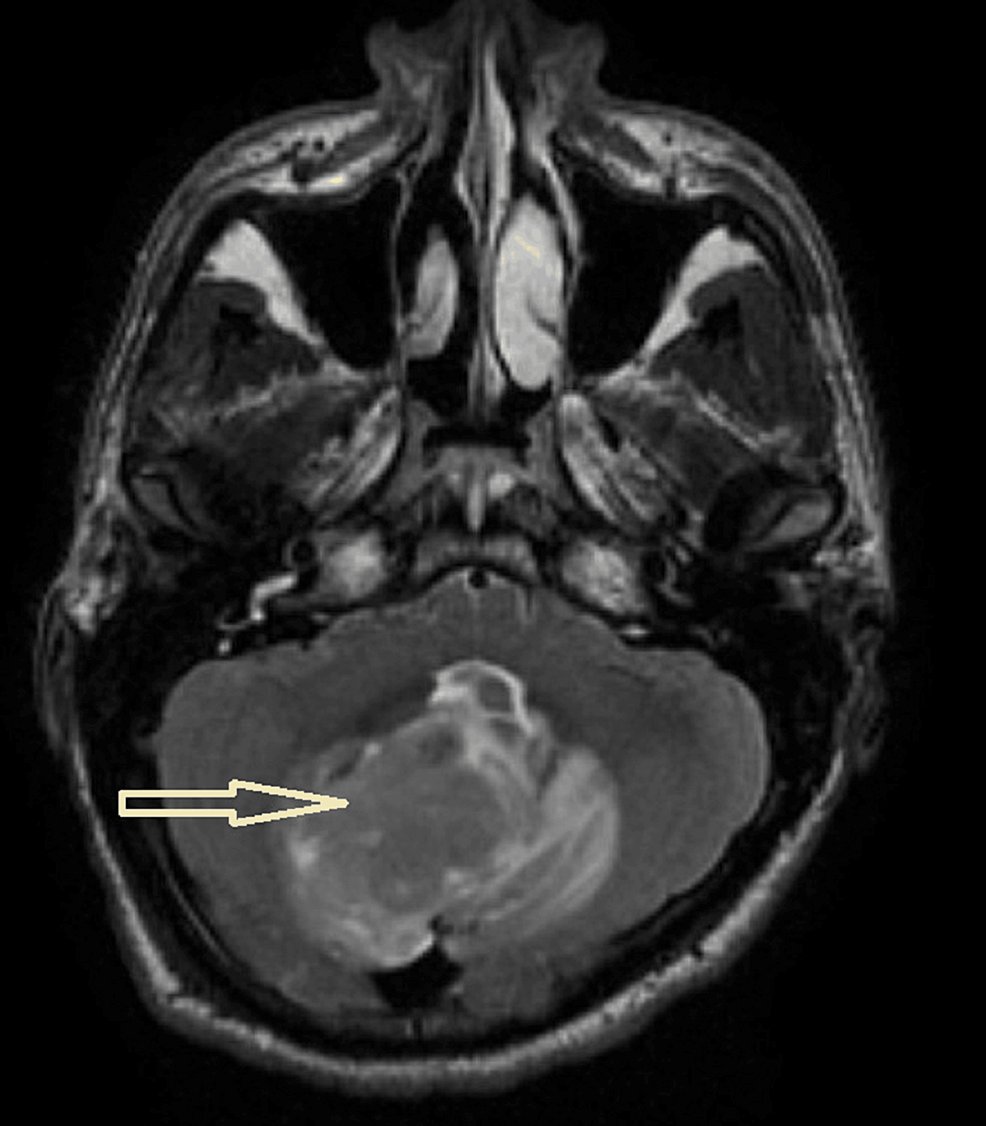 of medulloblastoma with melanotic and myogenic differentiation Extracranial Medulloblastoma With Myogenic Differentiation: Report of a  Rare Event