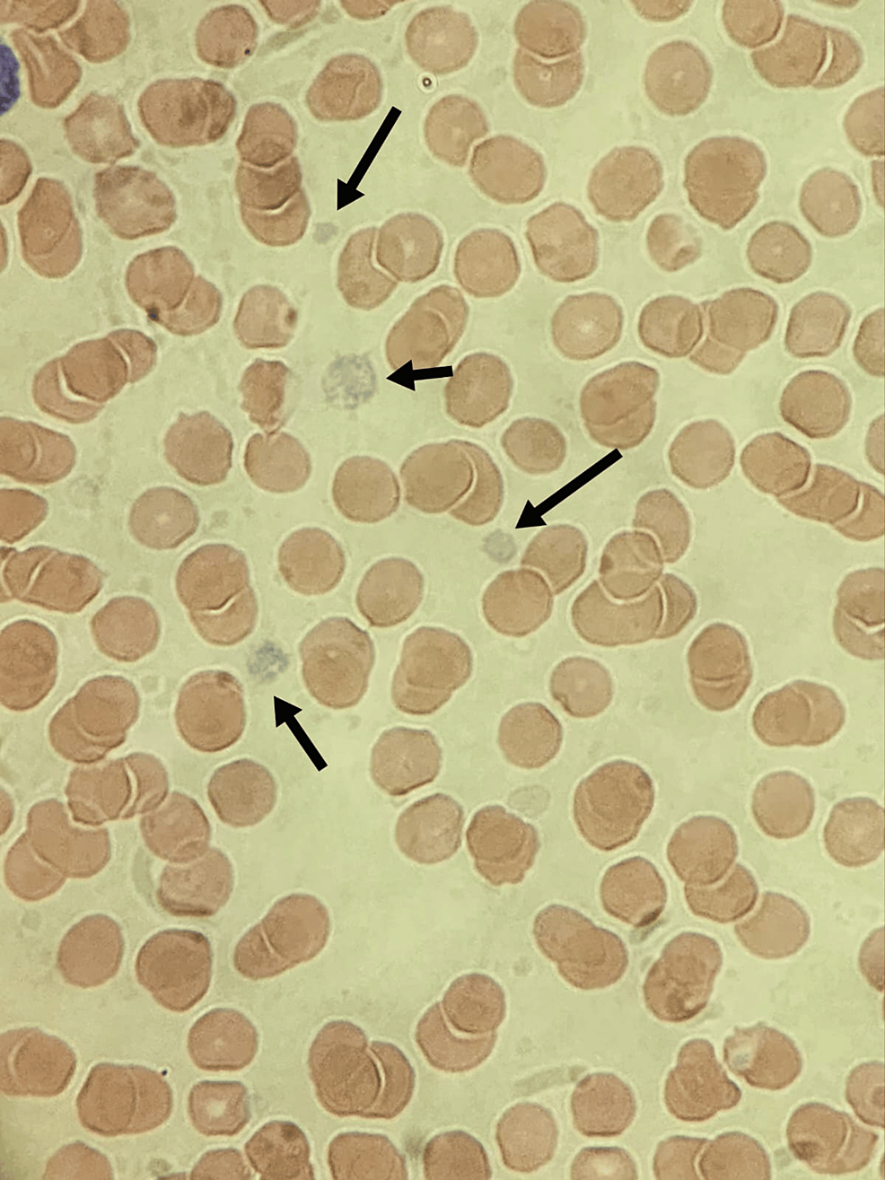 Cureus | Gray Platelet Syndrome in a Neonate With VACTERL Association ...