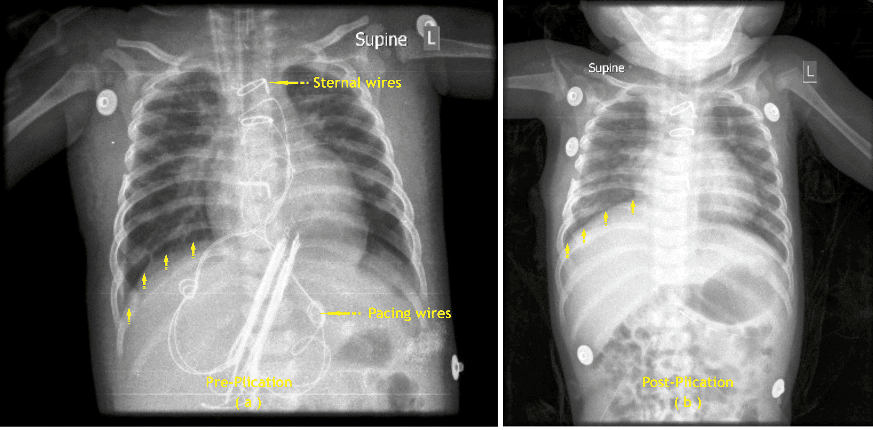 Cureus | Hemi-Diaphragm Plication and/or Tracheostomy Are Valuable ...