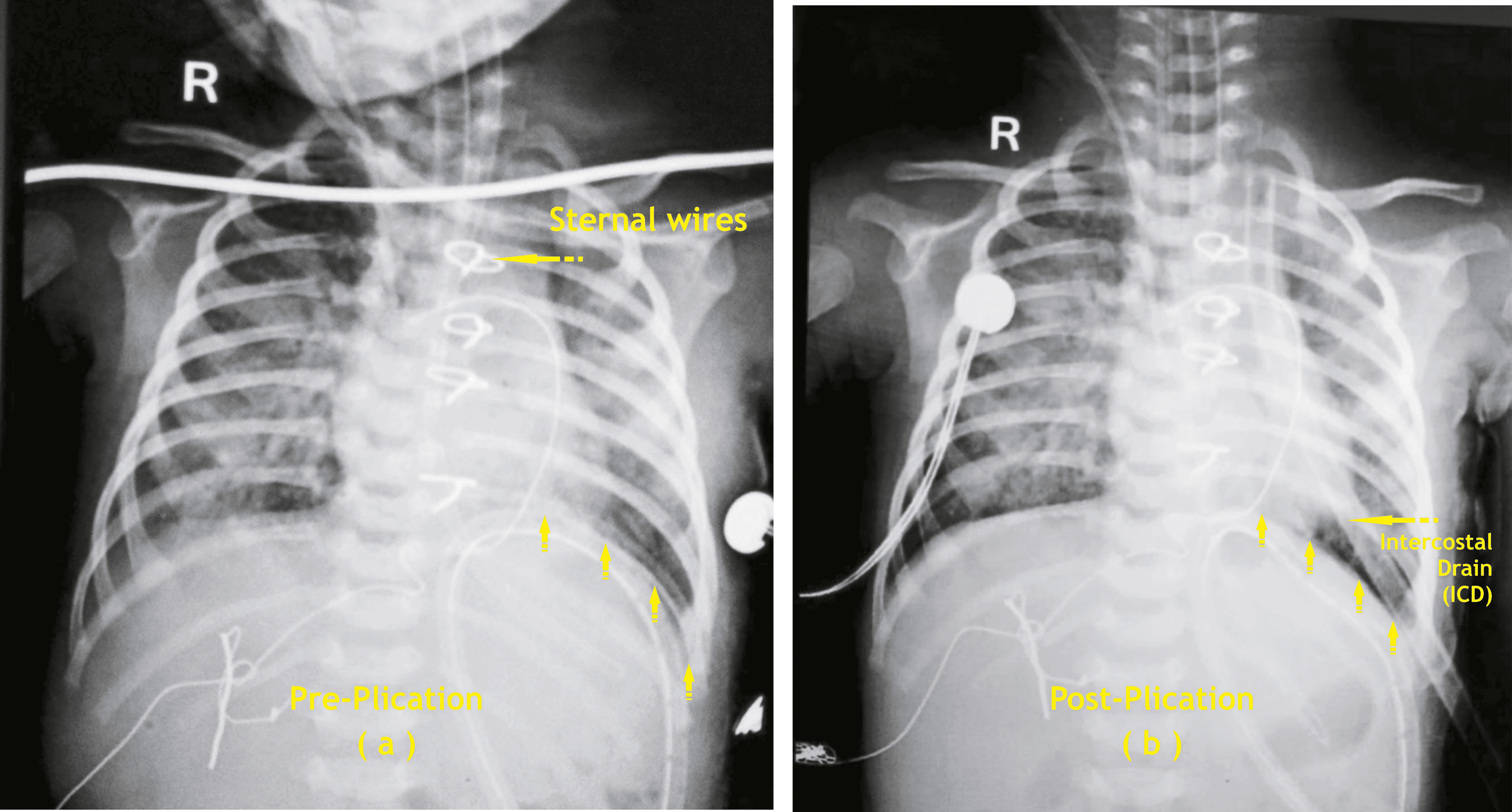 Cureus | Hemi-Diaphragm Plication and/or Tracheostomy Are Valuable ...