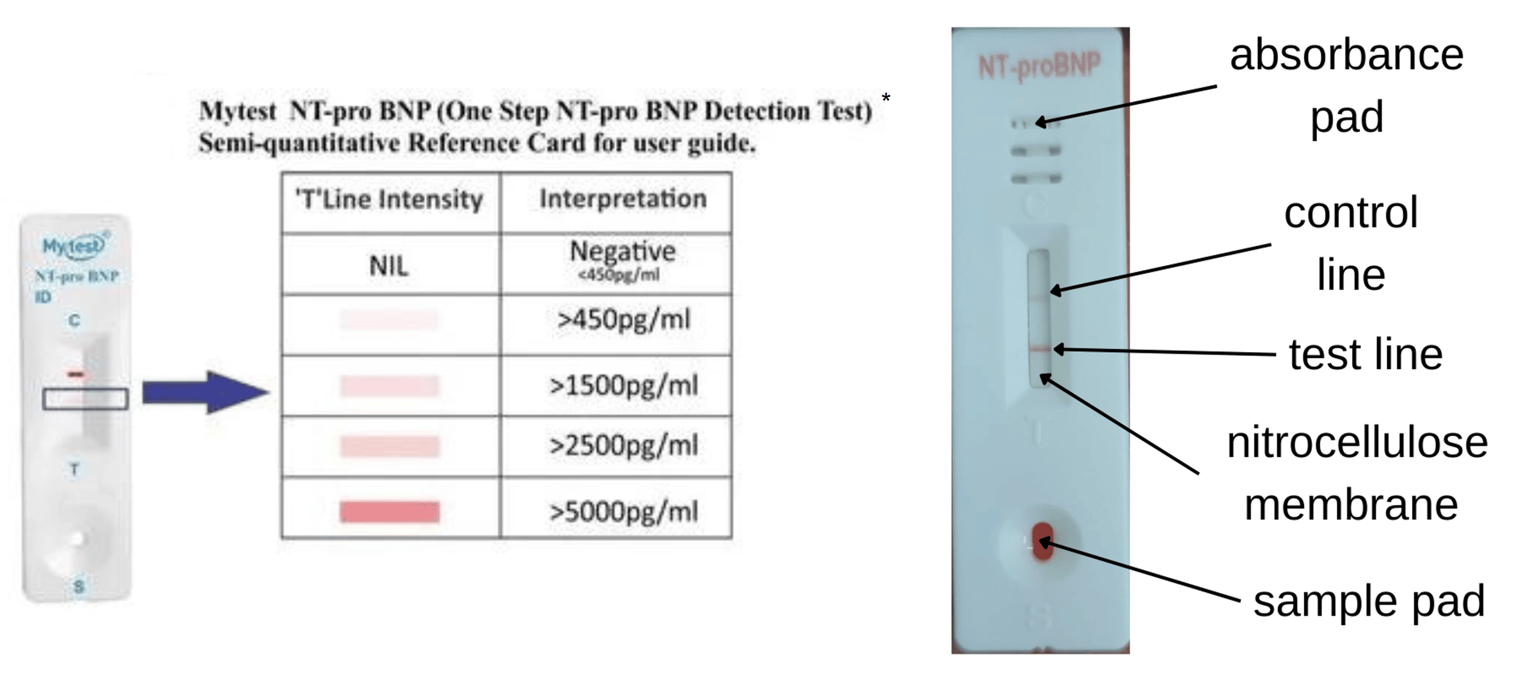 Cureus Rapid NTerminal ProBType Natriuretic Peptide (NTproBNP) Kit as a Differentiating