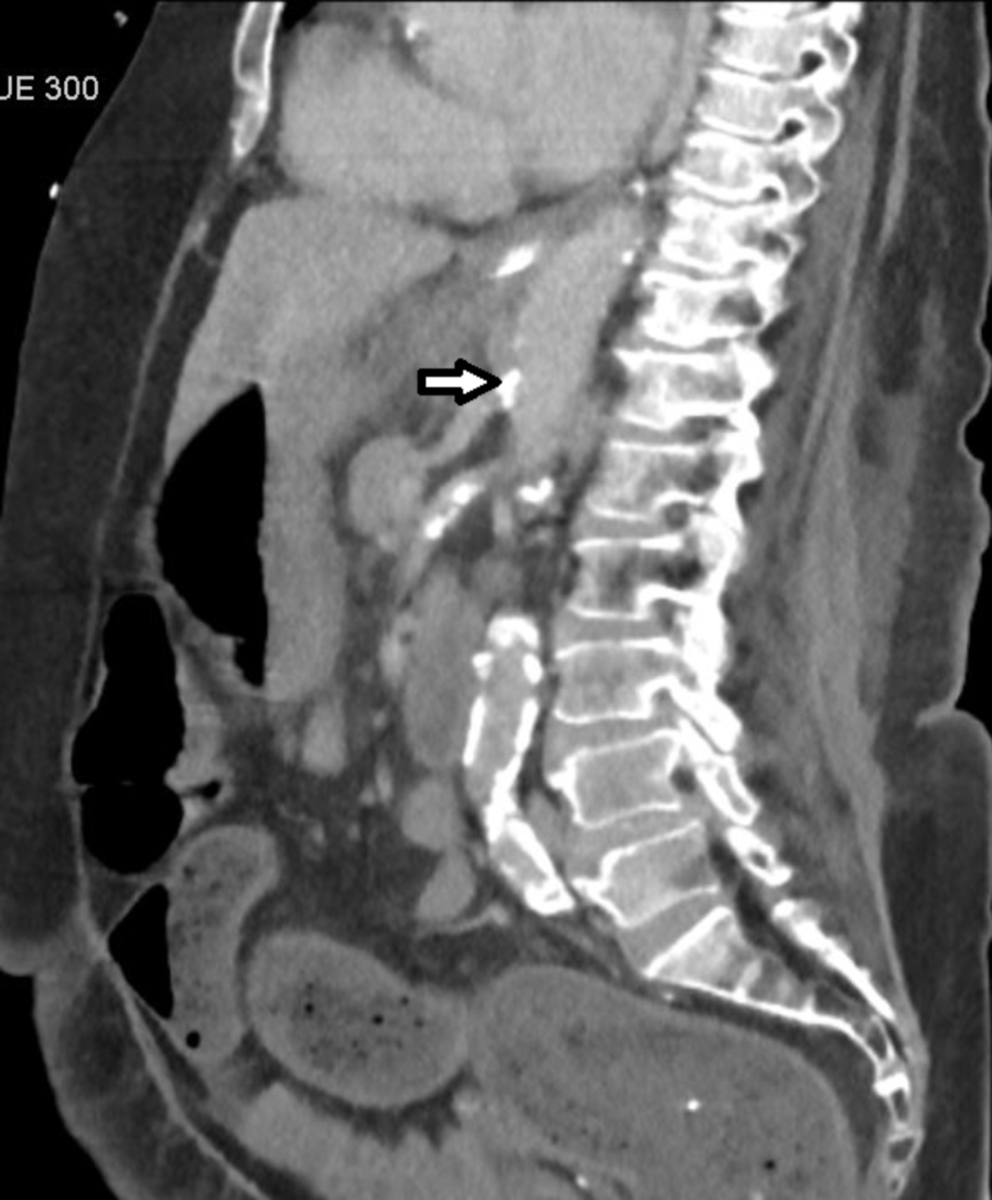 cureus-ischemic-gastropathy-treated-with-celiac-artery-revascularization