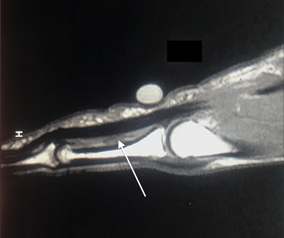 Cureus A Potentially Inexpensive Diagnostic Method for A2 Pulley Ruptures