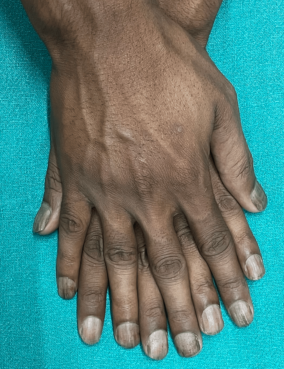 Fingernails with lichen planus disease - Stock Image - C058/5779 - Science  Photo Library