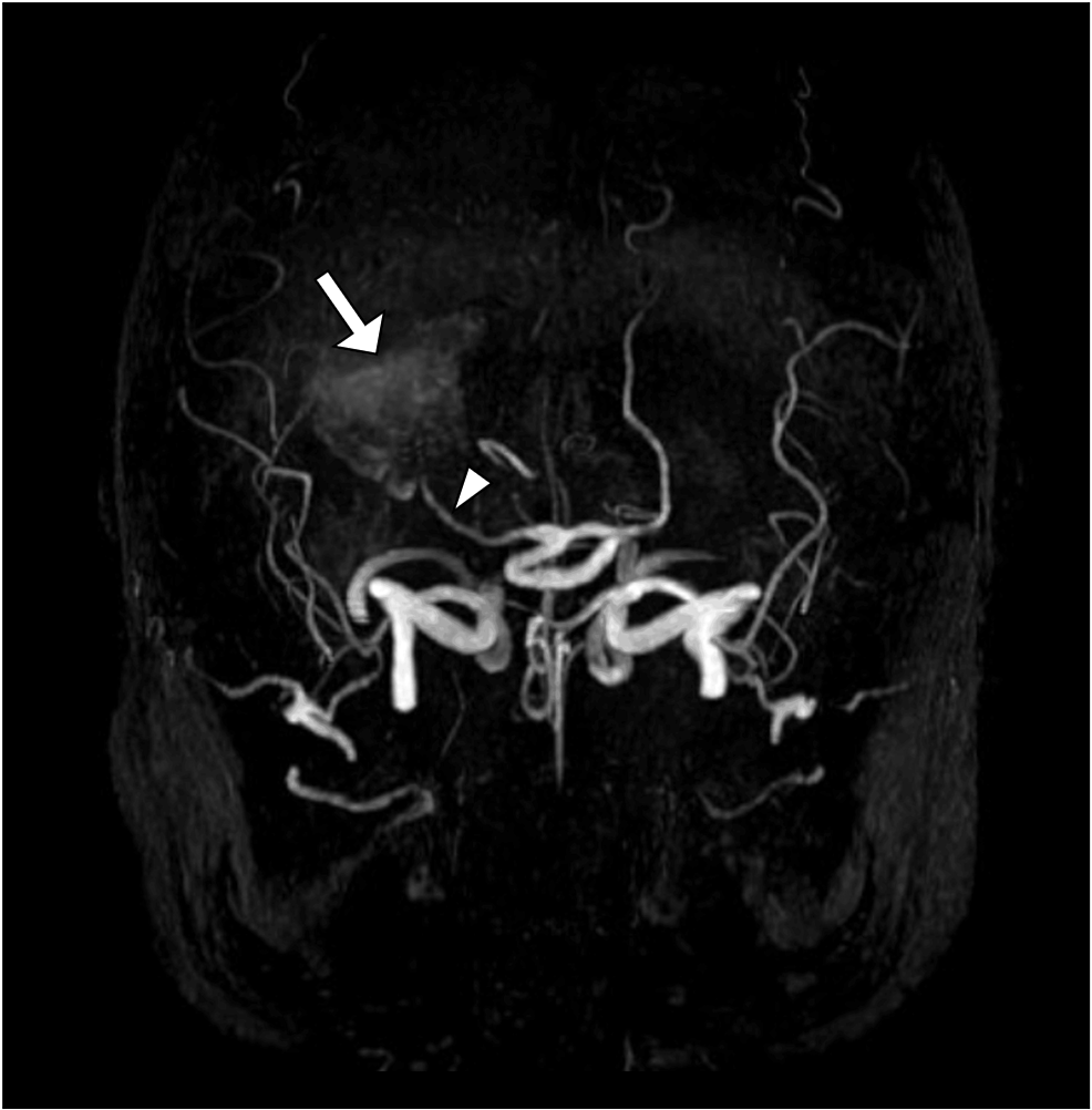La angiografía por resonancia magnética con volumen tridimensional revela la comunicación de la hemorragia observada previamente (señalada por una flecha blanca) y confirma que se trata de un gran aneurisma en la arteria cerebral posterior (señalado por una punta de flecha blanca).
