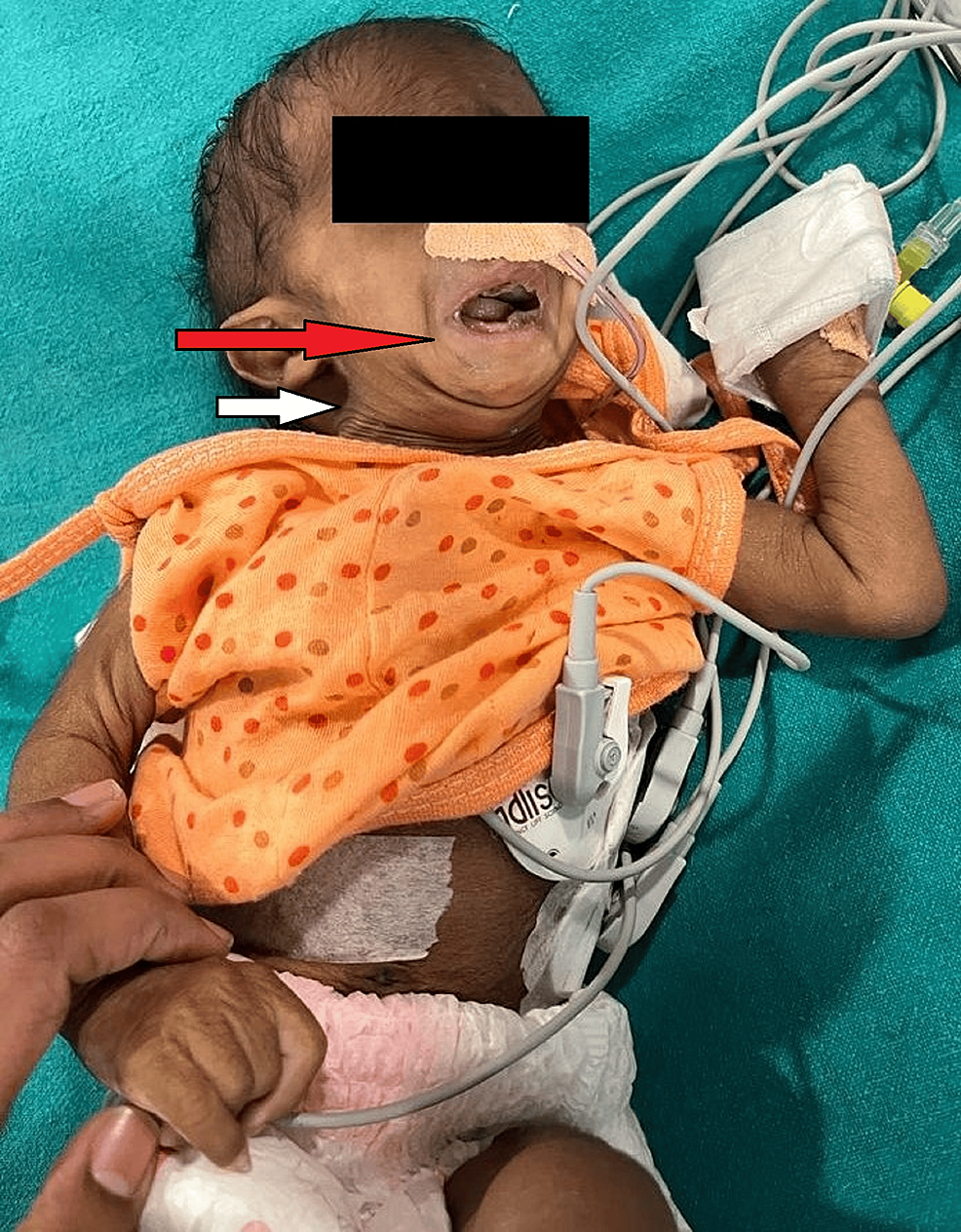 The-red-arrow-shows-retrognathia-and-the-white-arrow-shows-a-short-neck-indicative-of-anticipated-difficult-intubation The-red-arrow-shows-retrognathia-and-the-white-arrow-shows-a-short-neck-indicative-of-anticipated-difficult-intubation