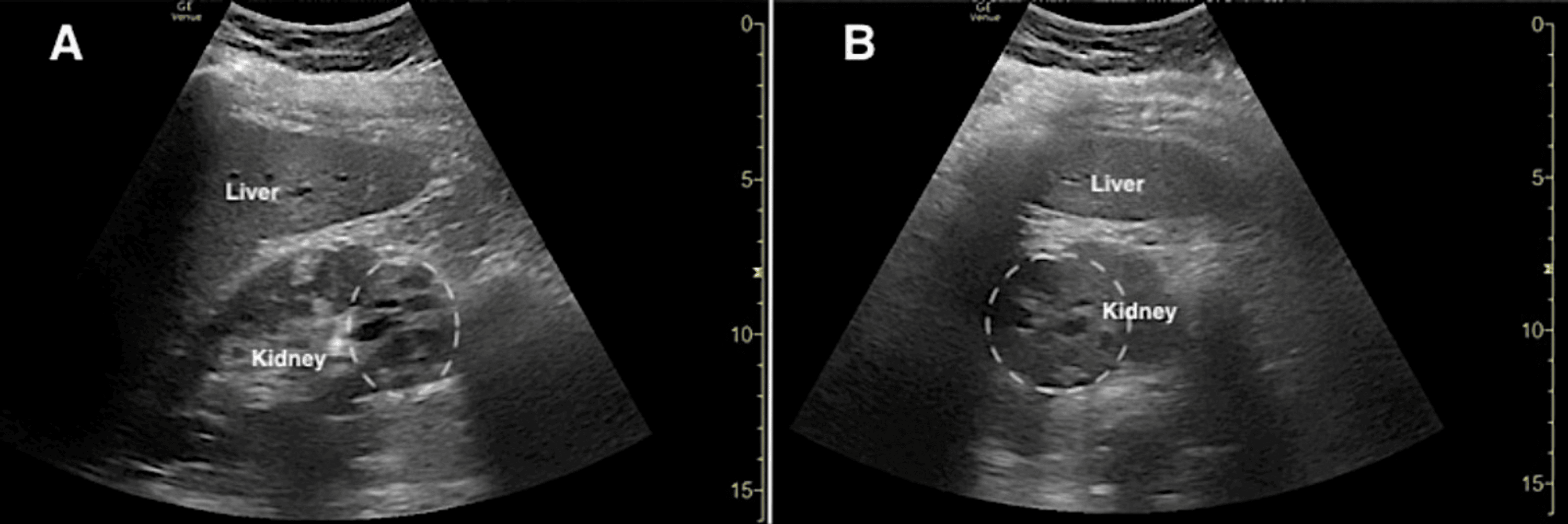 Emergency PhysicianPerformed PointofCare Ultrasound of a Renal Mass