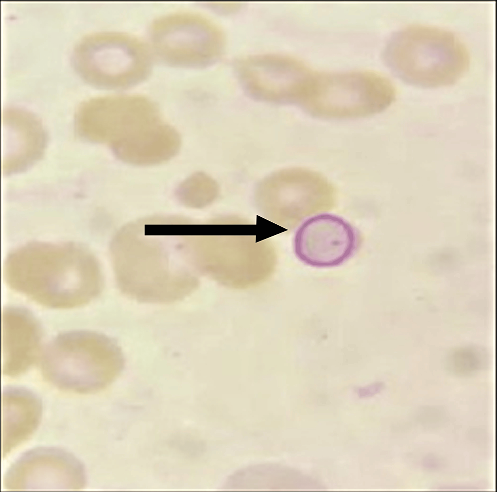 Congenital Dyserythropoietic Anemia Type I A Rare Case Report Cureus