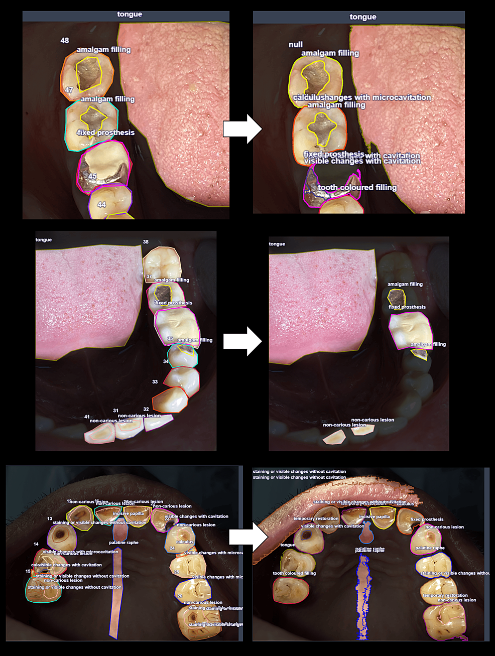 Clinical Annotation and Segmentation Tool (CAST) Implementation for
