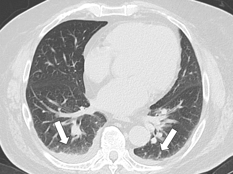 Primary Adrenal Insufficiency in Acute Progressive Systemic ...