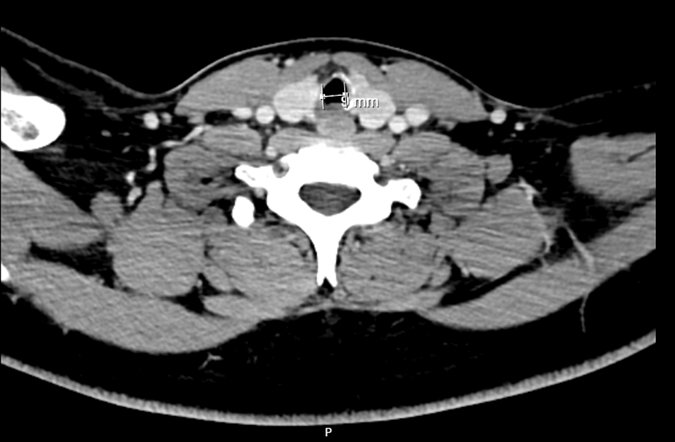 Axial-cervicothoracic-CT-scan-image-showing-a-subglottic-formation-and-a-minimum-diameter-of-9-mm-in-the-subglottic-larynx Axial-cervicothoracic-CT-scan-image-showing-a-subglottic-formation-and-a-minimum-diameter-of-9-mm-in-the-subglottic-larynx