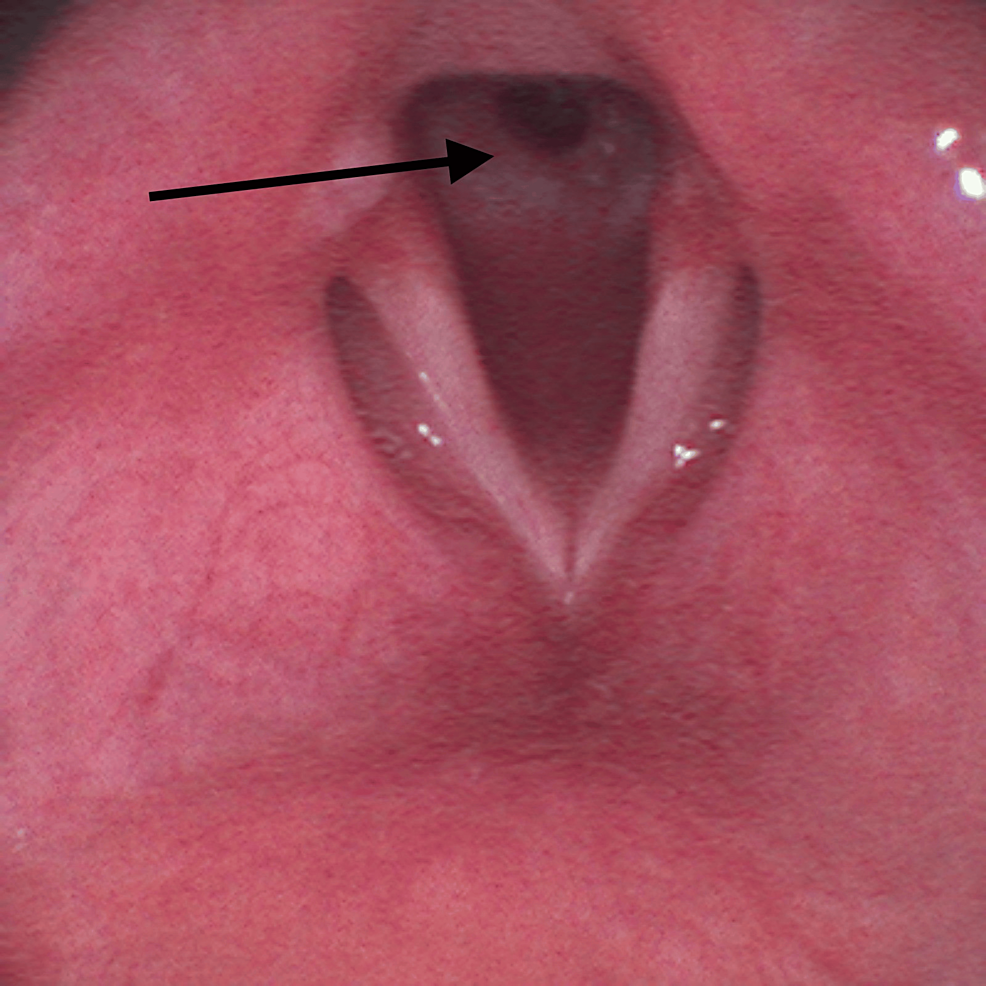 Circumferential-subglottic-fibrous-membrane-(arrow)-observed-during-asleep-fiberoptic-visualization Circumferential-subglottic-fibrous-membrane-(arrow)-observed-during-asleep-fiberoptic-visualization