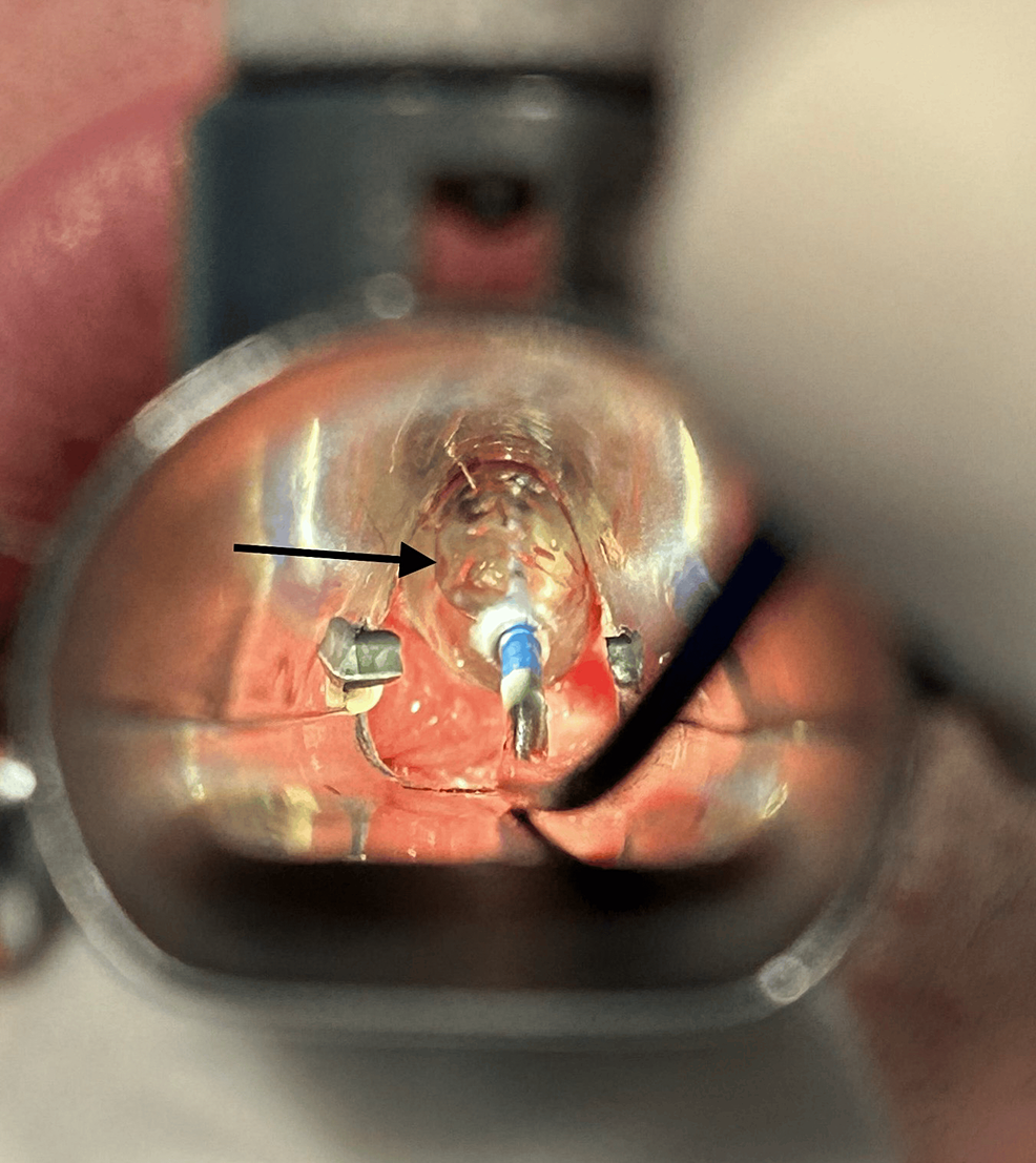 Balloon-dilatation-(arrow)-of-the-subglottic-stenosis Balloon-dilatation-(arrow)-of-the-subglottic-stenosis