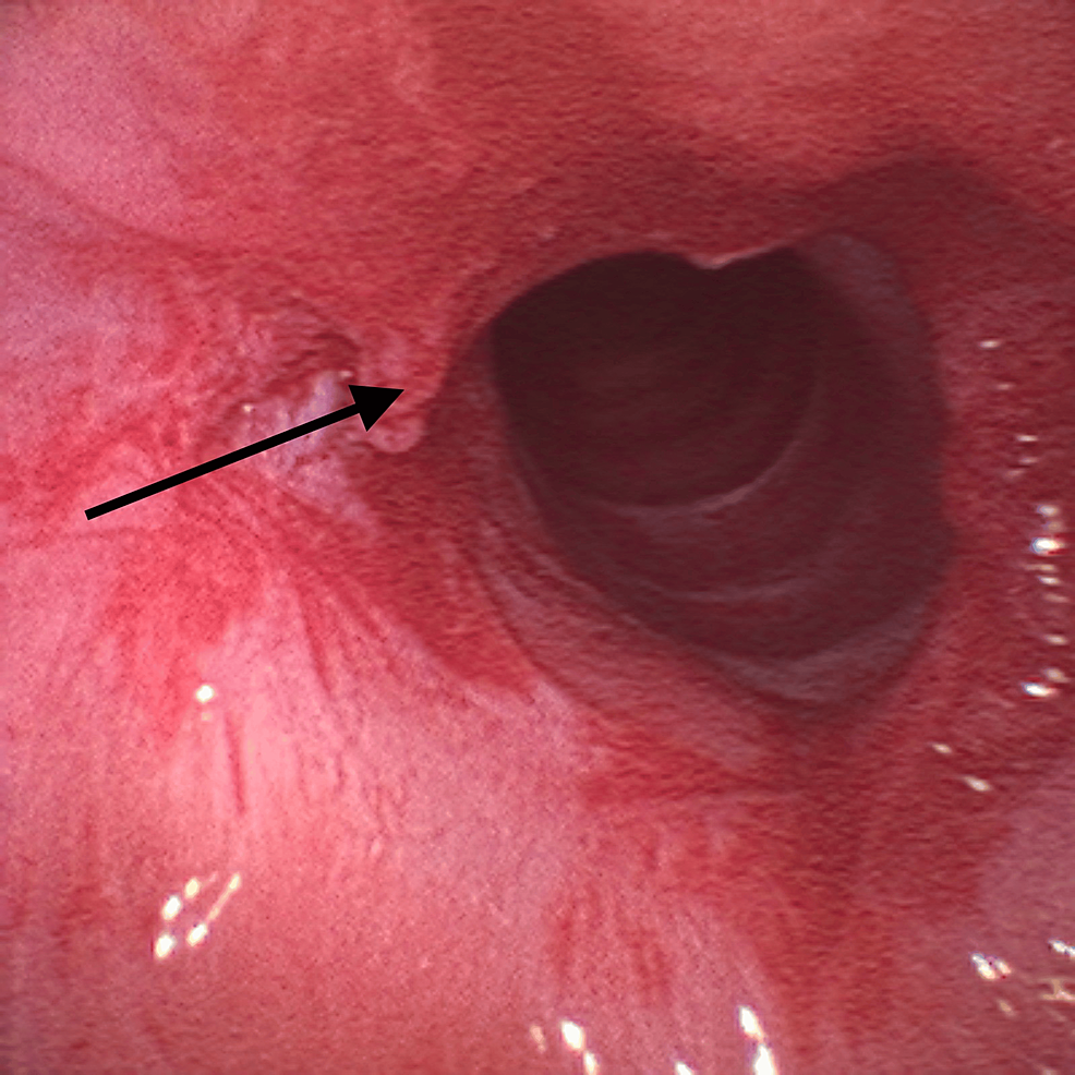 Minimal-portion-of-the-membrane-remaining-at-the-end-of-surgery-(arrow) Minimal-portion-of-the-membrane-remaining-at-the-end-of-surgery-(arrow)