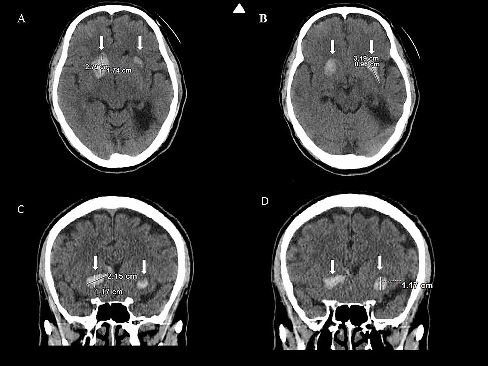 Cureus Nontraumatic Spontaneous Bilateral Basal Ganglia Hemorrhage A Rare Case Report