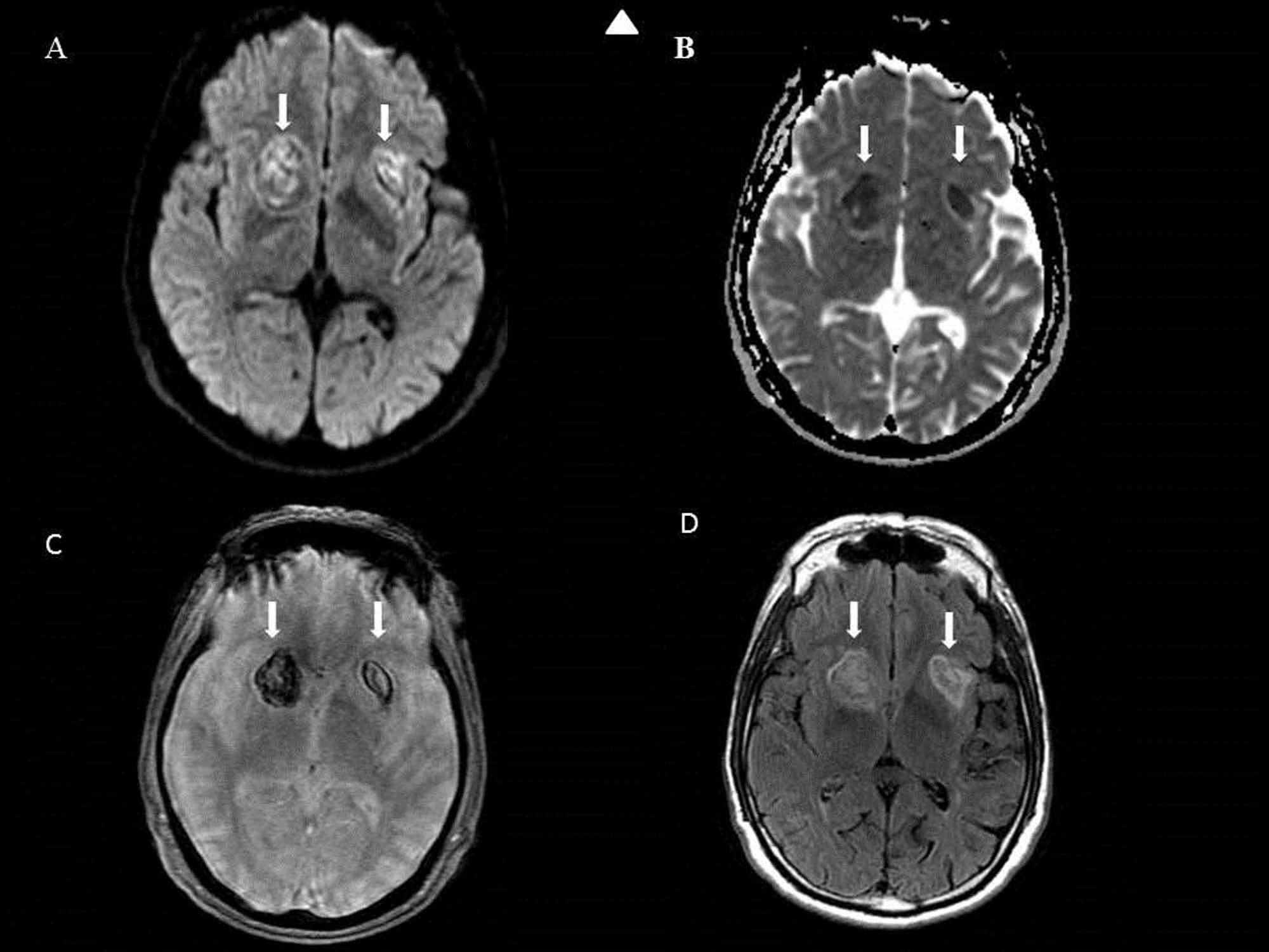 Cureus Nontraumatic Spontaneous Bilateral Basal Ganglia Hemorrhage A Rare Case Report