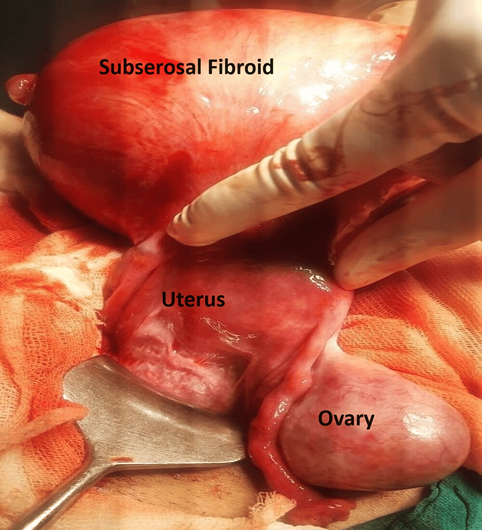 Uterine Torsion: A Rare Condition in a Nullipara Woman