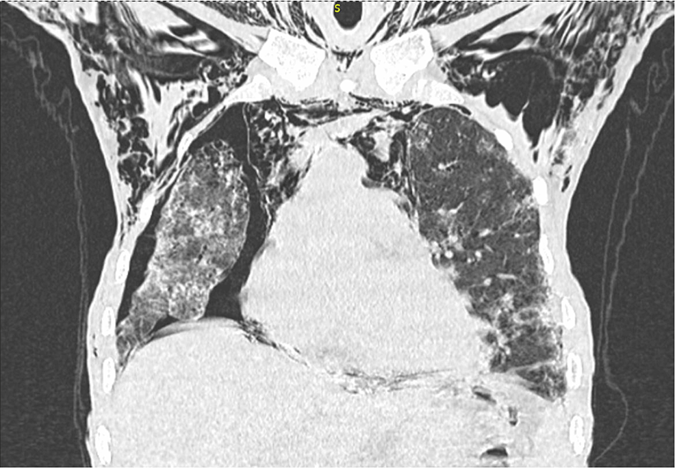 Rapidly Progressive Interstitial Lung Disease With Pneumothorax and