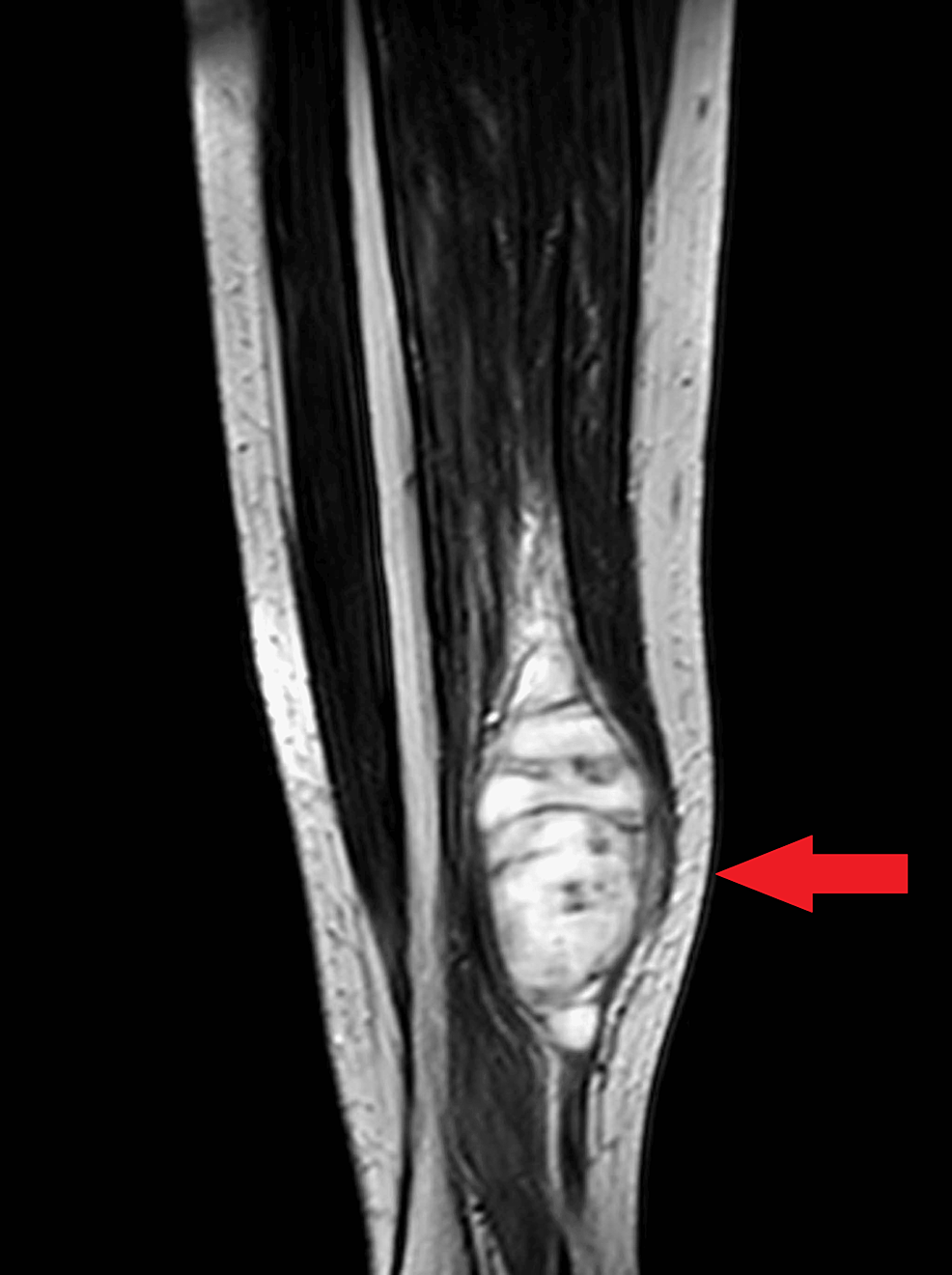 El dolor crónico de las extremidades inferiores revela un caso raro de sarcoma de tejido blando de células fusiformes: una odisea diagnóstica