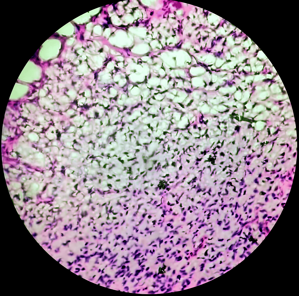 Cureus Chronic Lower Limb Pain Unveiling a Rare Case of Spindle Cell
