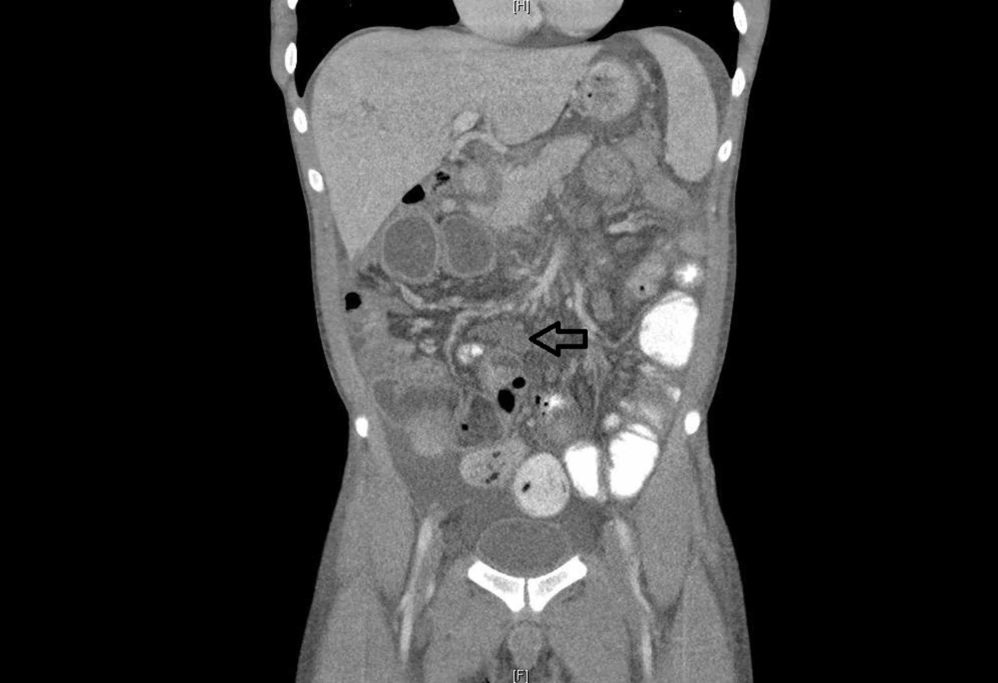 Inguinal Lymph Nodes Abdomen